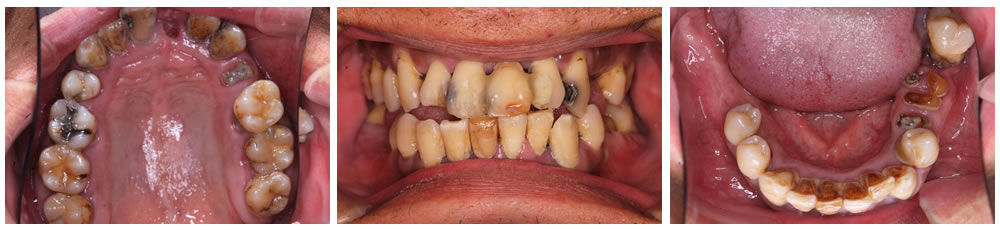 歯周内科治療前