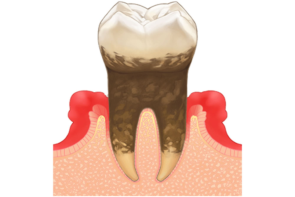歯周組織回復