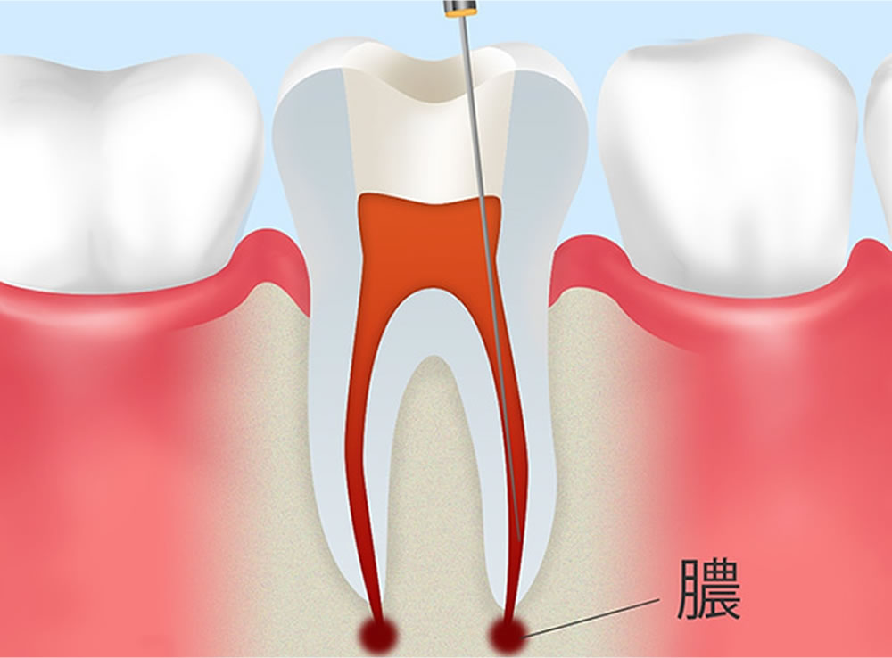 根尖処置